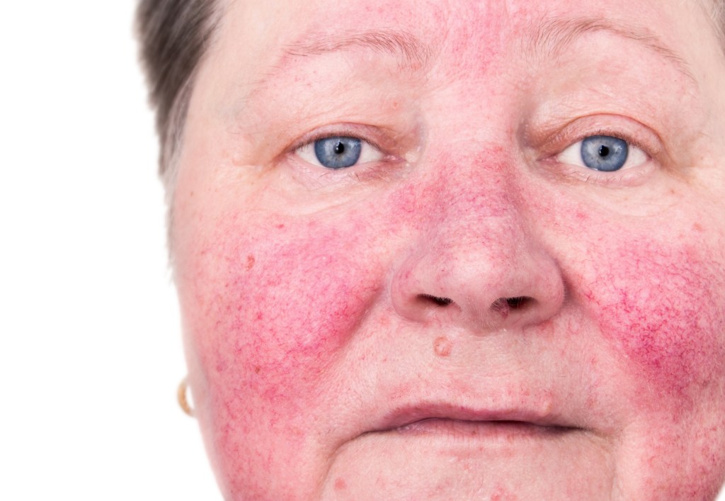 Frau mit Rosacea